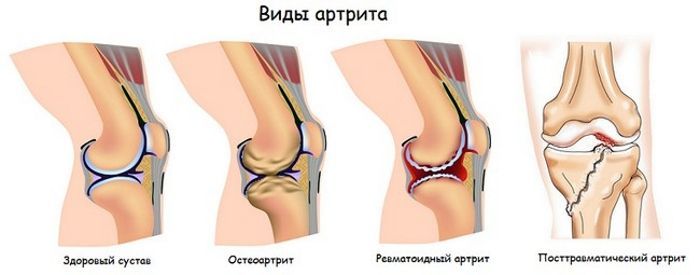 Существует множество видов артритов. Каждый вид проявляет себя по-своему и лечится также. Существует множество видов артритов. Каждый вид проявляет себя по-своему и лечится также.