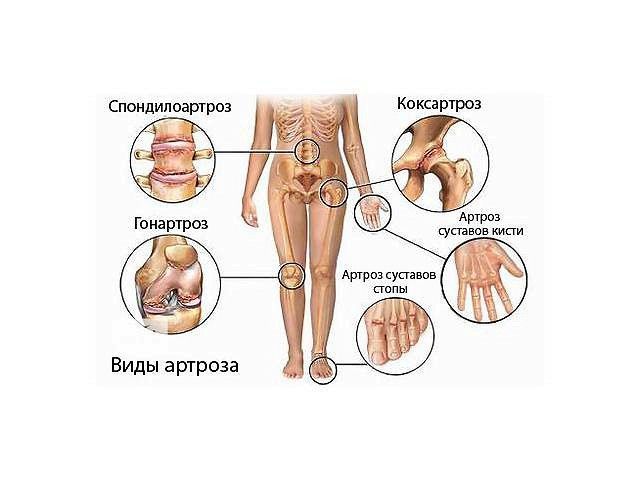 Существует несколько видов артроза. Существует несколько видов артроза.