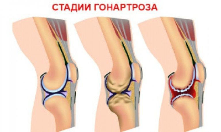 Существуют 3 стадии гонартроза. Существуют 3 стадии гонартроза.