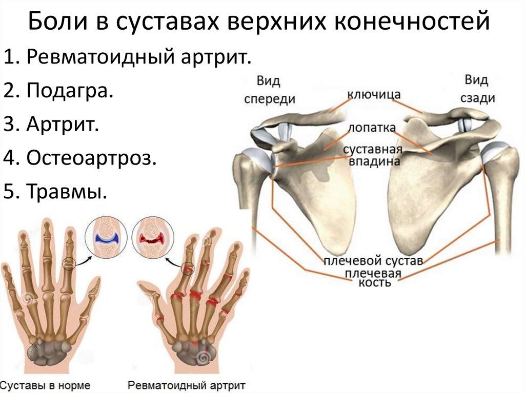 Боли в суставах верхних конечностей Боли могут иметь различные причины