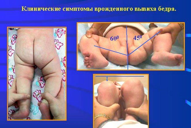 У новорожденных малышей дисплазия проявляет себя рядом клинических симптомов. У новорожденных малышей дисплазия проявляет себя рядом клинических симптомов.