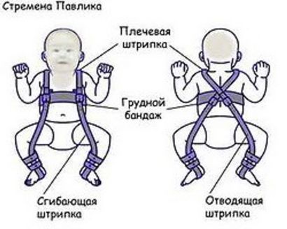 В лечении дисплазии таза у малышей часто используют стремена Павлика. В лечении дисплазии таза у малышей часто используют стремена Павлика.