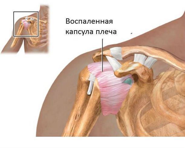 Воспаление капсулы сустава Особенности патологии