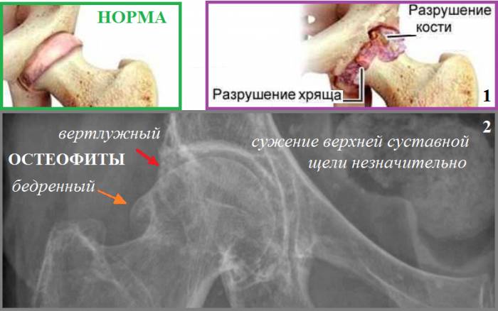 Коксартроз (1) и рентген остеофитов, вызывающие фемороацетабулярный синдром (2) Коксартроз (1) и рентген остеофитов, вызывающие фемороацетабулярный синдром (2)