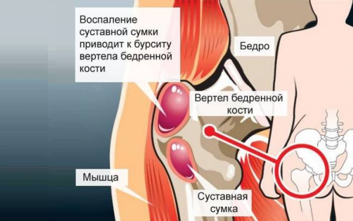 Локализация вертельного бурсита Локализация вертельного бурсита